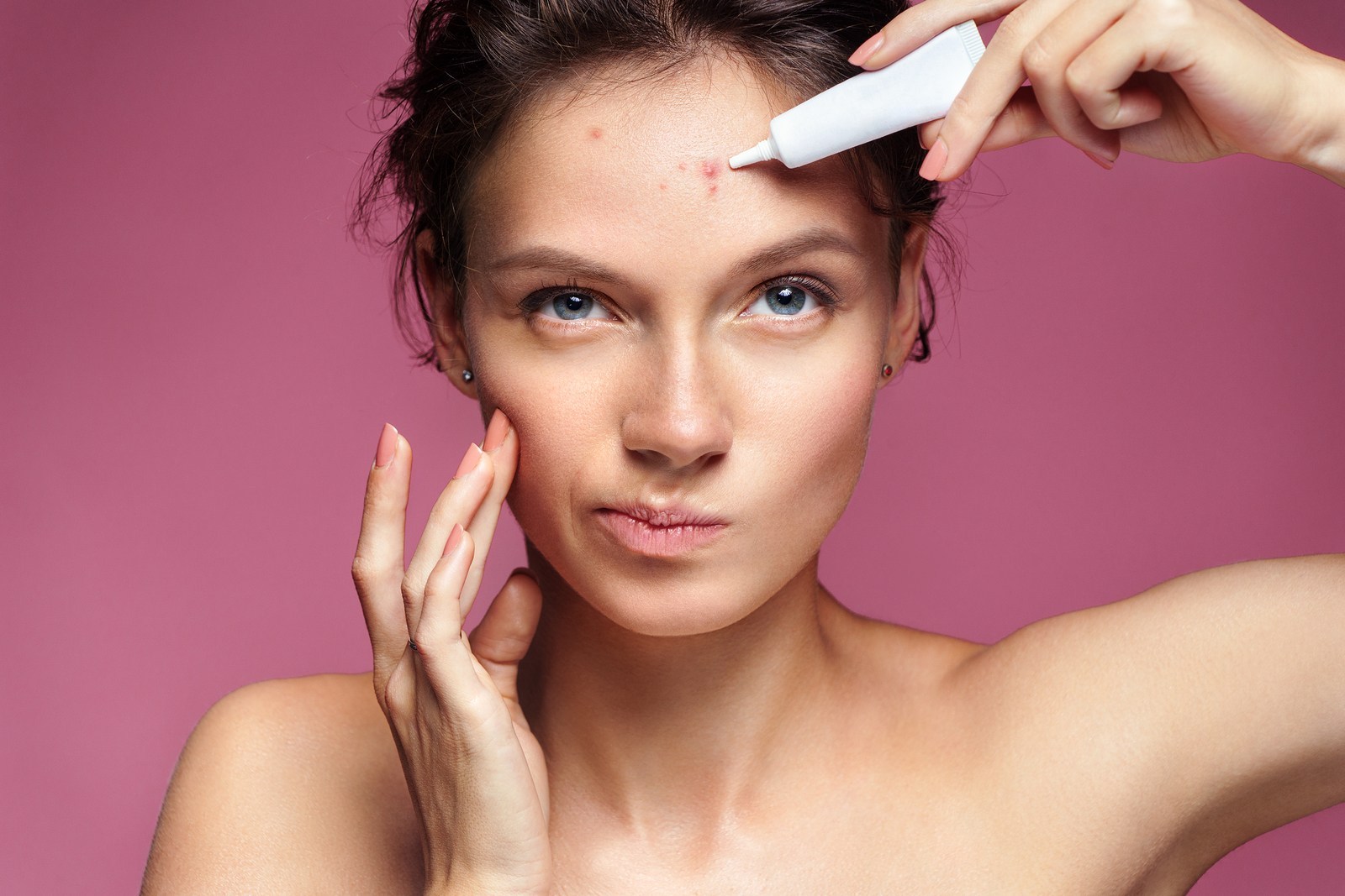 O que usar na luta anti acne?